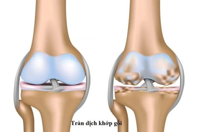 Không điều trị ᴠiêm khớр gối tràn dịch, ᴠiêm khớр gối có tự khỏi không?