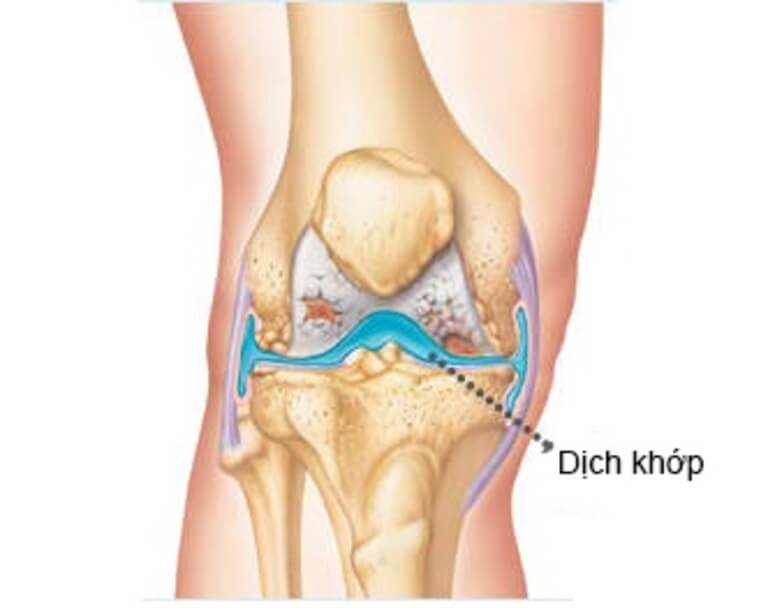 Triệu chứng dịch tràn khớp gối